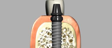 Implant Placement